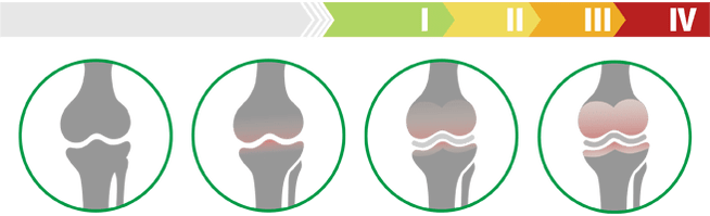 Stades cliniques de l'arthrose de l'articulation du genou (degré d'arthrose de l'articulation du genou)