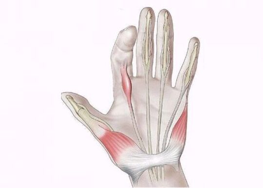 inflammation des tendons en tant que cause de douleur dans les articulations des doigts