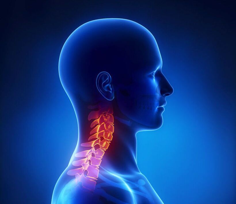 L'ostéochondrose cervicale est une pathologie de la colonne vertébrale, dont vous pouvez vous débarrasser à la maison