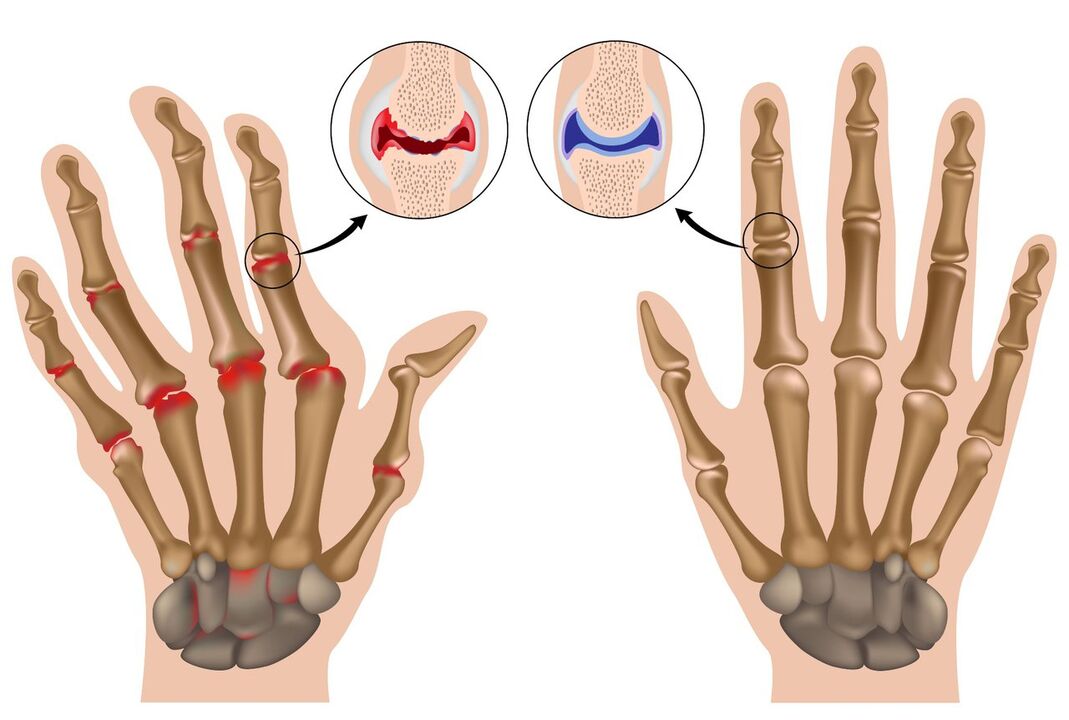 Articulations des mains saines et atteintes de polyarthrite