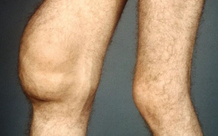 Arthrose post-traumatique de l'articulation du genou