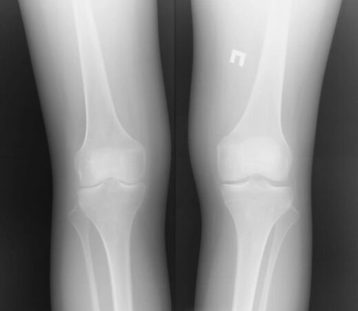 La radiographie de l'articulation du genou