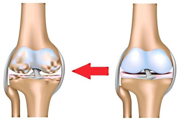 Articulation et arthrose saines