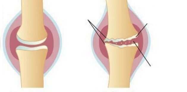 Laver le cartilage