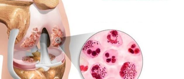 ce qui conduit au développement de l'arthrose