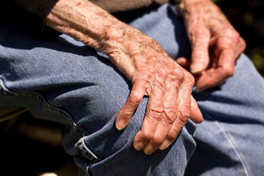 L'arthrose est une maladie liée à l'âge qui survient chez les personnes âgées