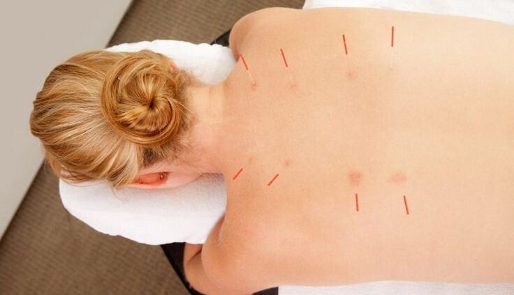 L'acupuncture pour l'ostéochondrose thoracique, qui présente de nombreux avantages